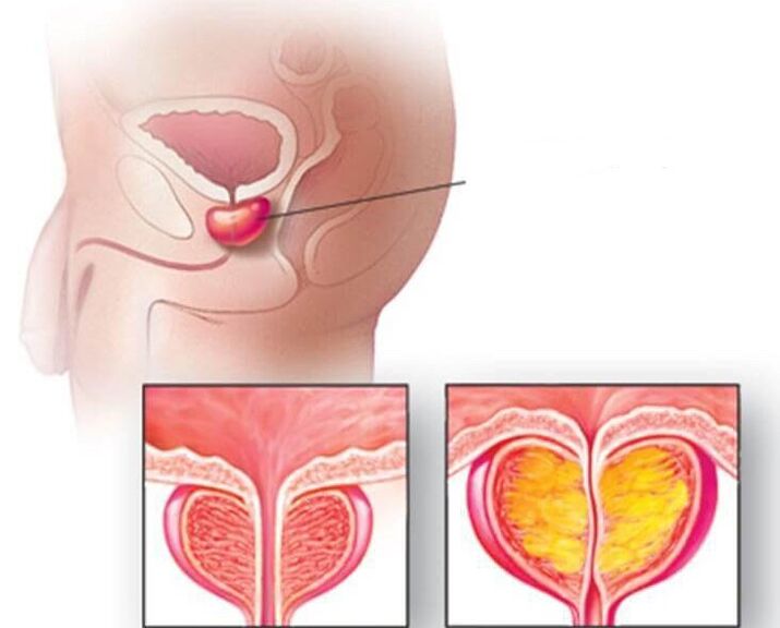 Lage der Prostata, normale und vergrößerte Prostata bei chronischer Prostatitis. 