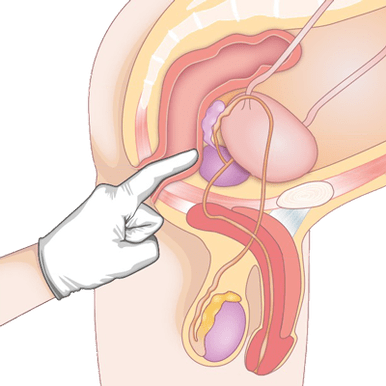 Bestimmung des Zustands der Prostata durch Abtasten zur Diagnose einer Prostatitis. 