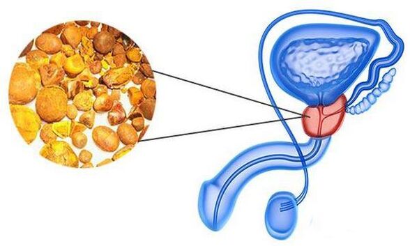 Prostatitisprobleme