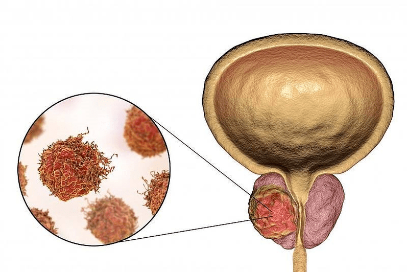 Wie sieht eine Schädigung der Prostata aus
