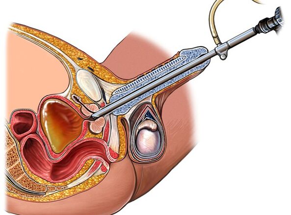 Behandlung von Prostatitis