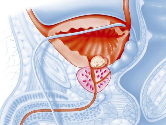 bakterielle Prostatitis